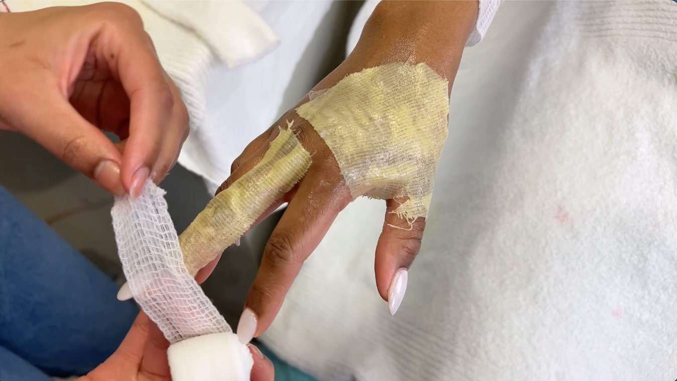 wrapping net gauze around a finger that has 'greasy gauze' for burn wounds